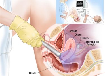 ultrasonido vaginal. alt