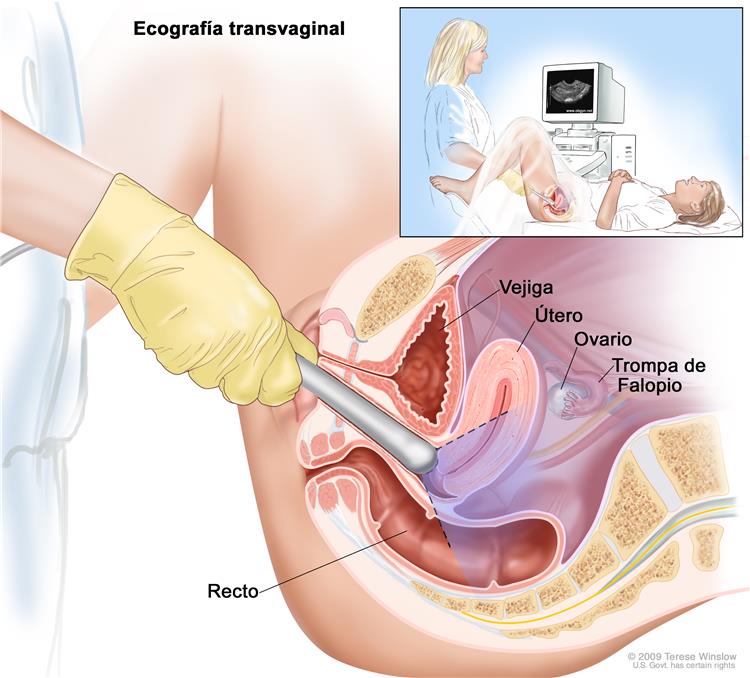 ultrasonido vaginal. alt