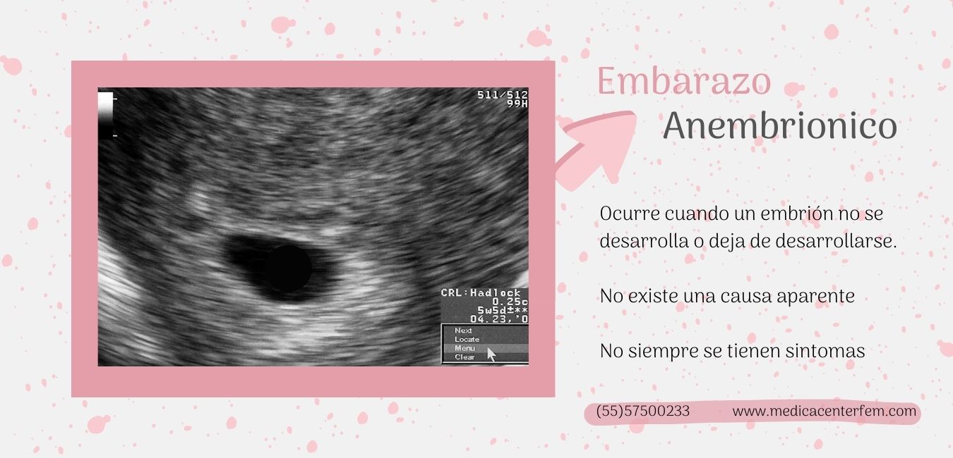 embarazo-anembrionico